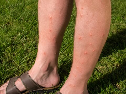 Mister Zanzara — gambe e caviglie costellate di punture di zanzara all'aperto sul prato